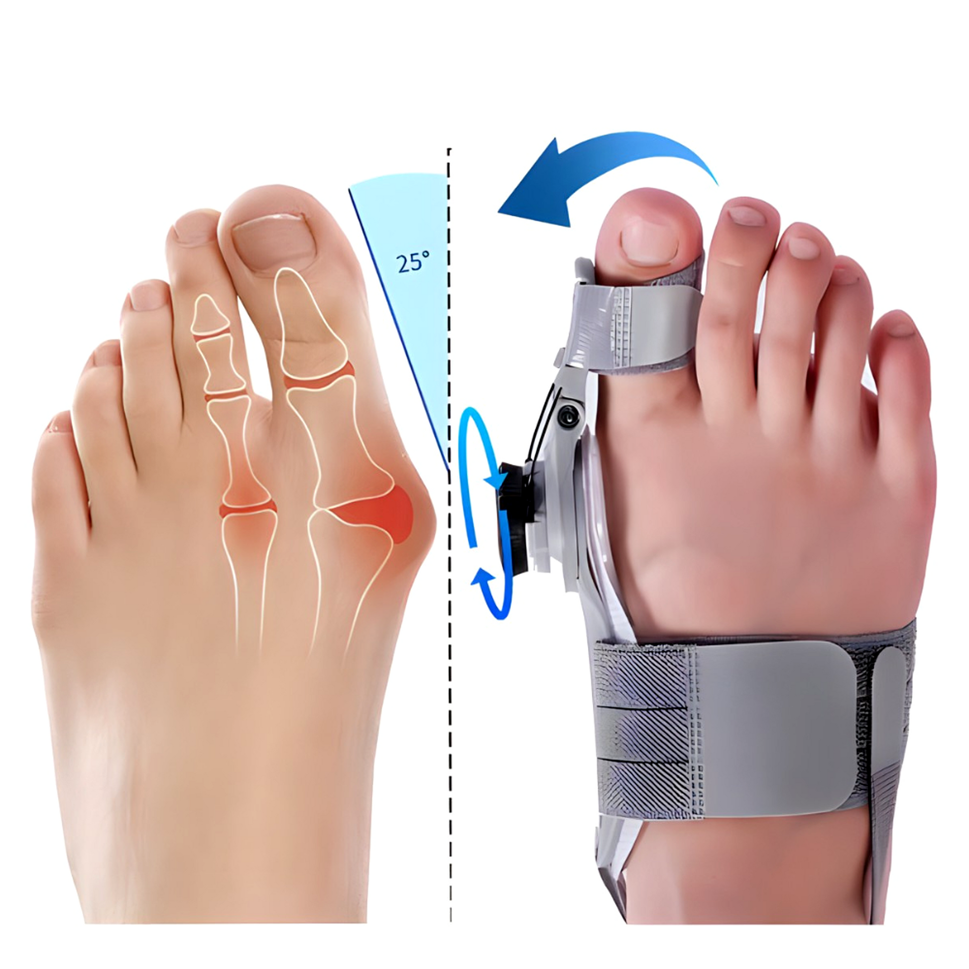 AussiePick Bunion Alignment Support